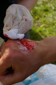 Outdoor First Aid Hand Injury